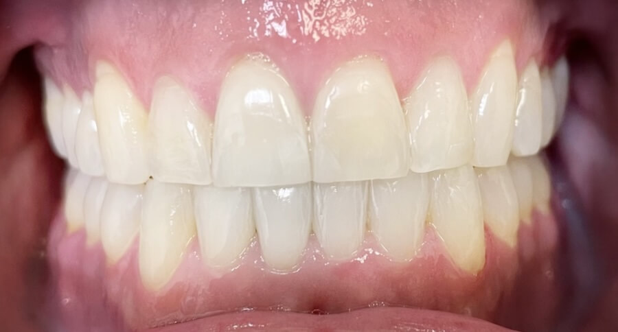 Invisalign After