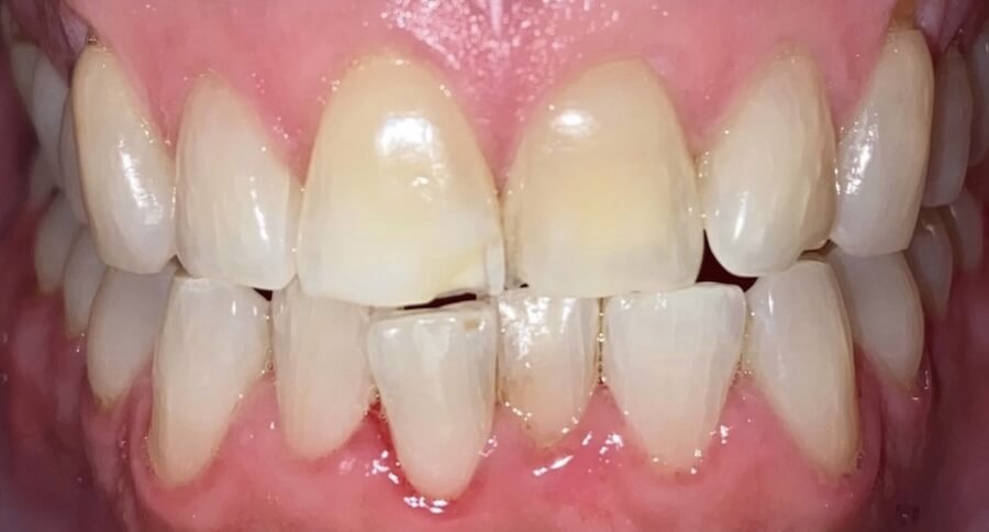 Invisalign Before