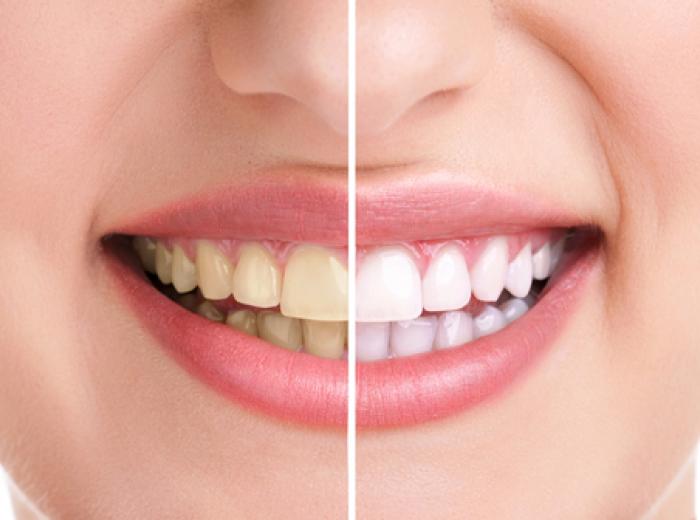 Everything You Ever Needed to Know About Teeth Whitening