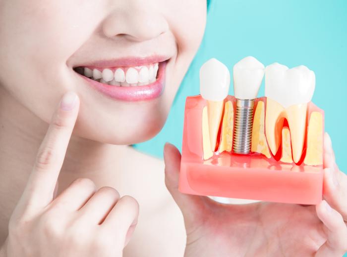5 Fascinating Facts About Dental Implants