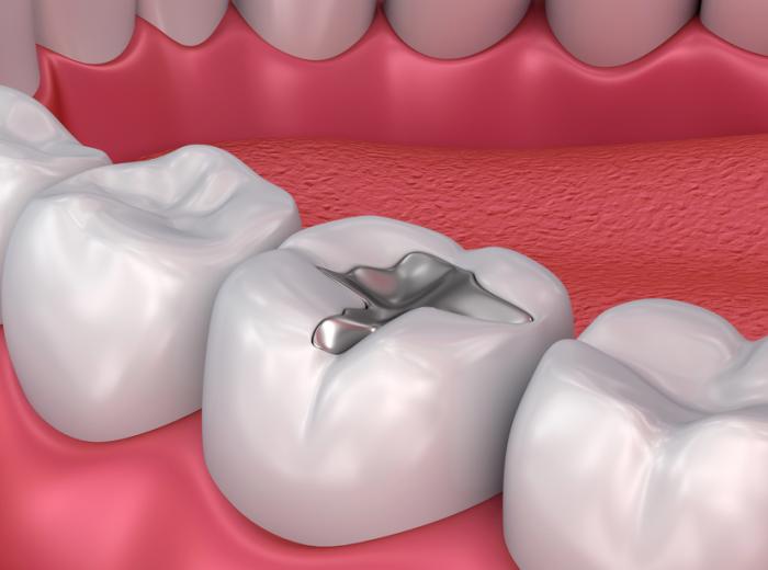 Choosing the Right Teeth Fillings: A Guide to Materials and Longevity