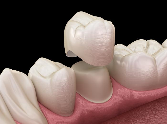 Fillings vs. Dental Crowns: Choosing the Right Solution for Your Smile