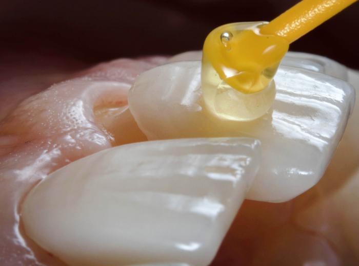 Your Ultimate Guide to Porcelain Dental Veneers