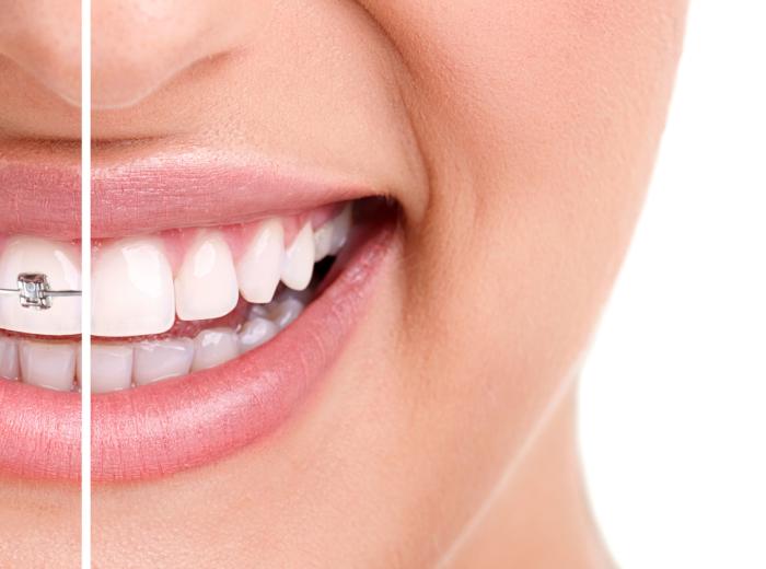 Invisalign® vs. Braces: Which is right for me?