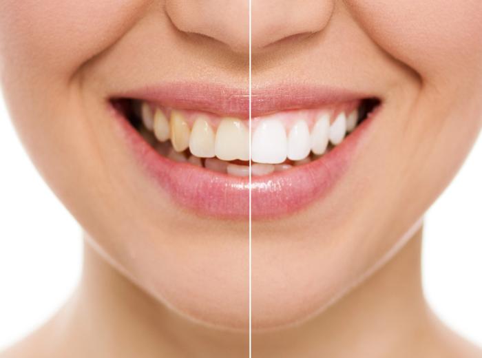Teeth Whitening vs. Dental Veneers: Which Option is Right for You?