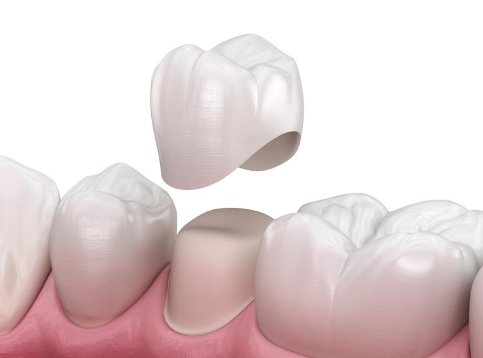 Need a Dental Crown? Two Visits, One Strong Smile