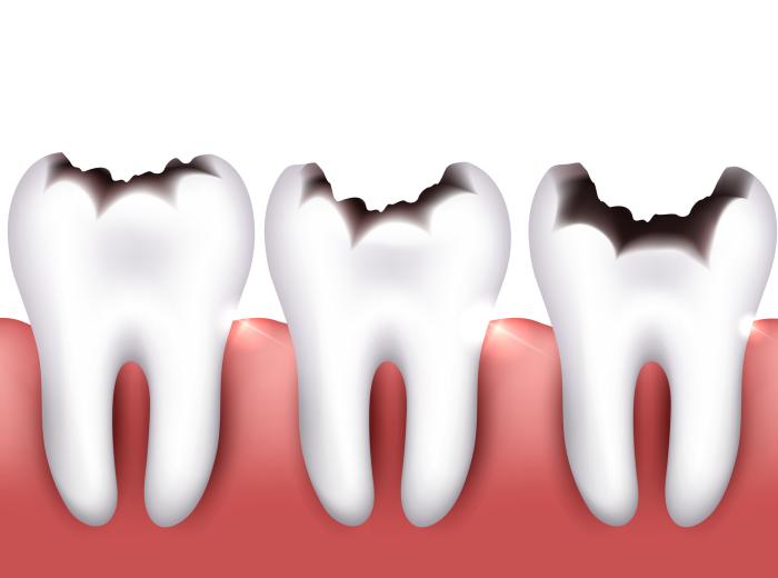 How Fast Do Cavities Grow?