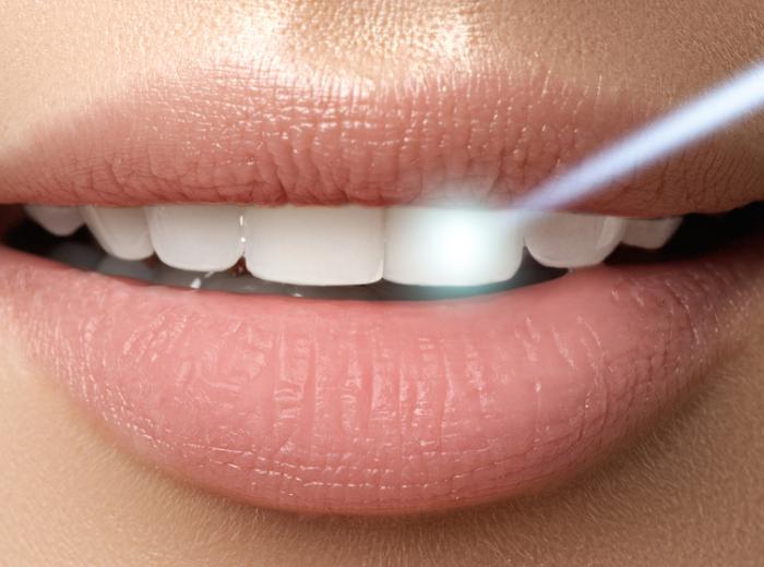 Dentist in Las Vegas Answers: Is Teeth Whitening Safe for Sensitive Teeth?