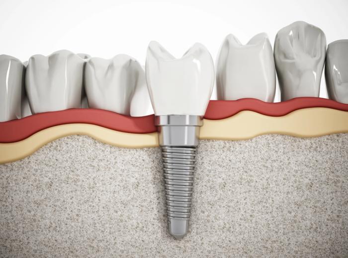 How Dental Implants Can Help Prevent Premature Aging
