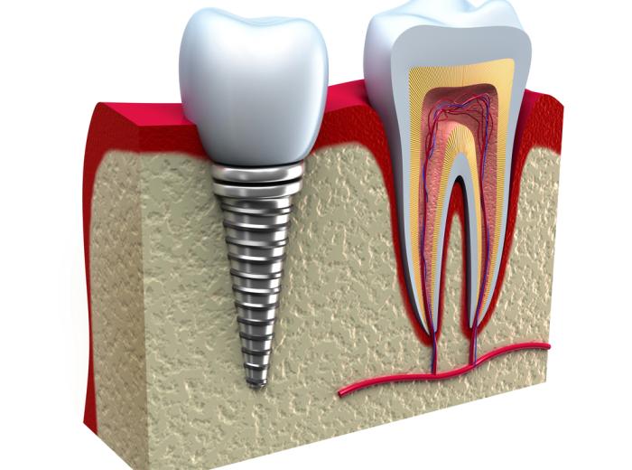 Caring for Your Dental Implants: Tips for Long-Lasting Results