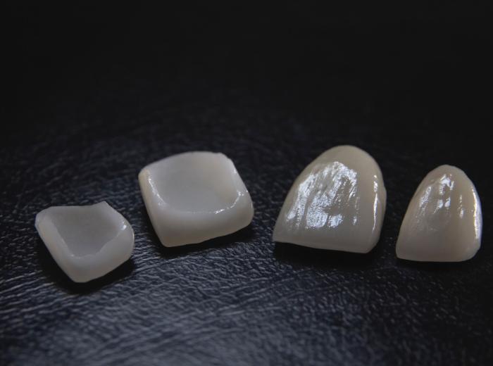 Composite Resin vs. Porcelain Dental Veneers: Choosing the Right Smile Enhancement