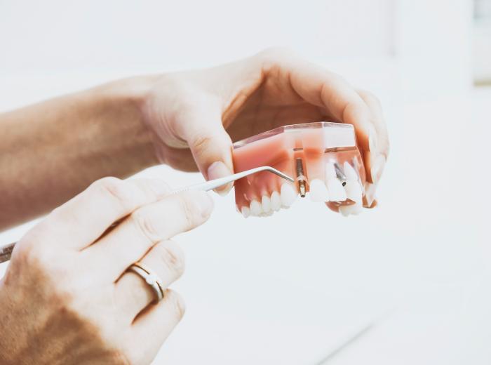 How to Become a Prime Candidate for Dental Implants