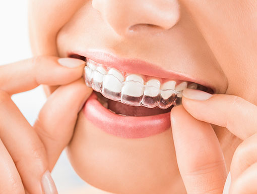 Veneers vs. Invisalign: Which Is Right for Me?