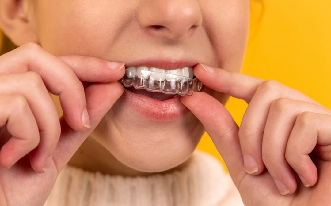 “How can I speed up Invisalign treatment?” & Other Clear Aligner FAQs