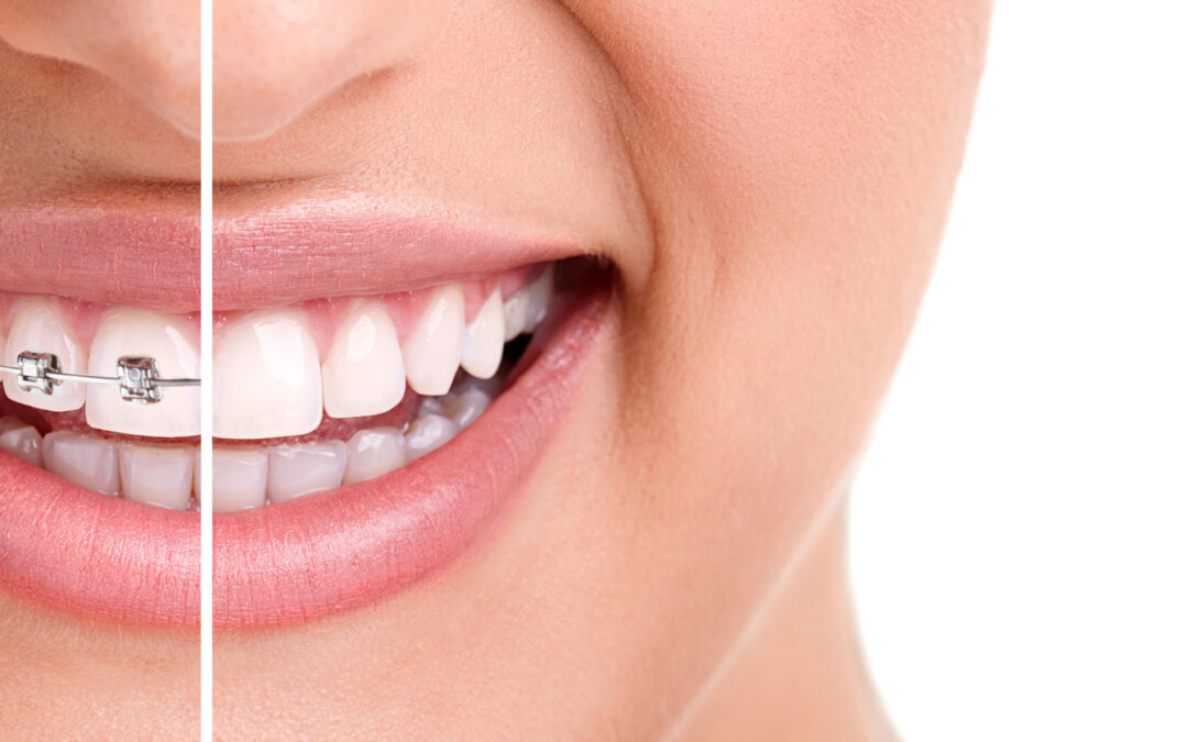 Invisalign® vs. Braces: Which is right for me?