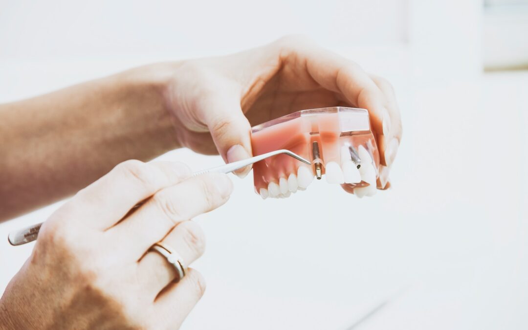 How to Become a Prime Candidate for Dental Implants