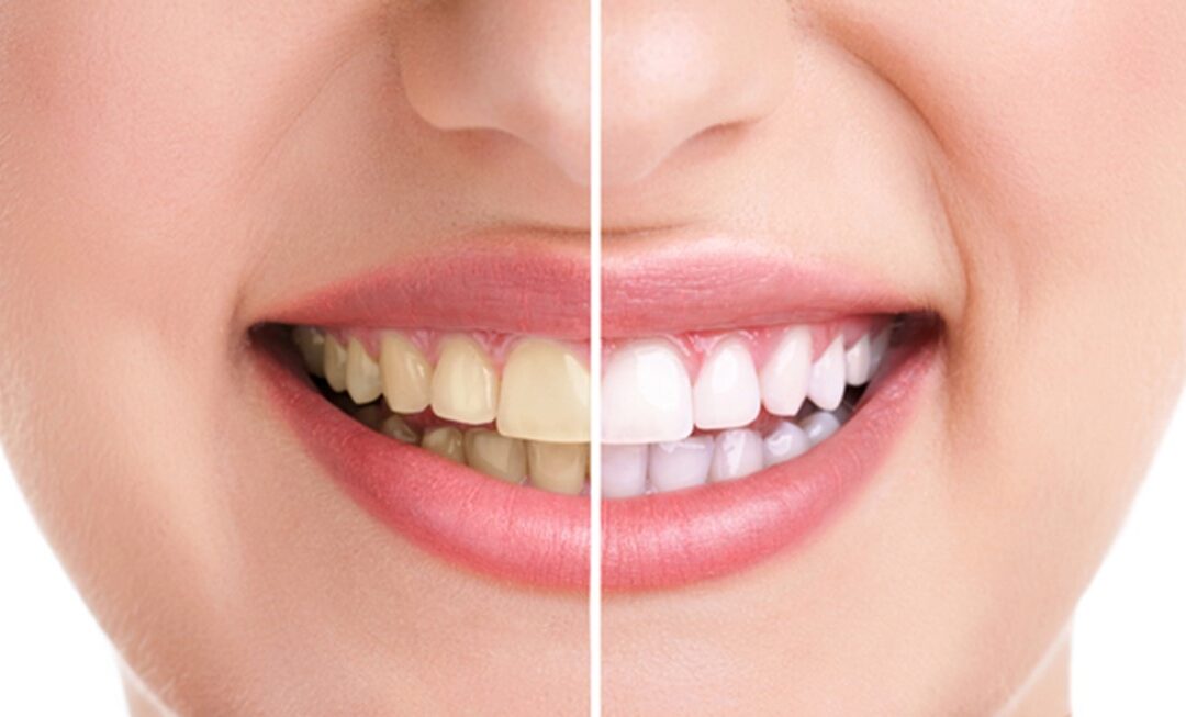 5 Benefits of Professional Teeth Whitening