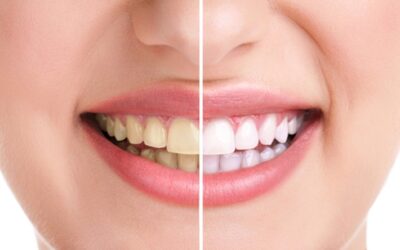 5 Benefits of Professional Teeth Whitening