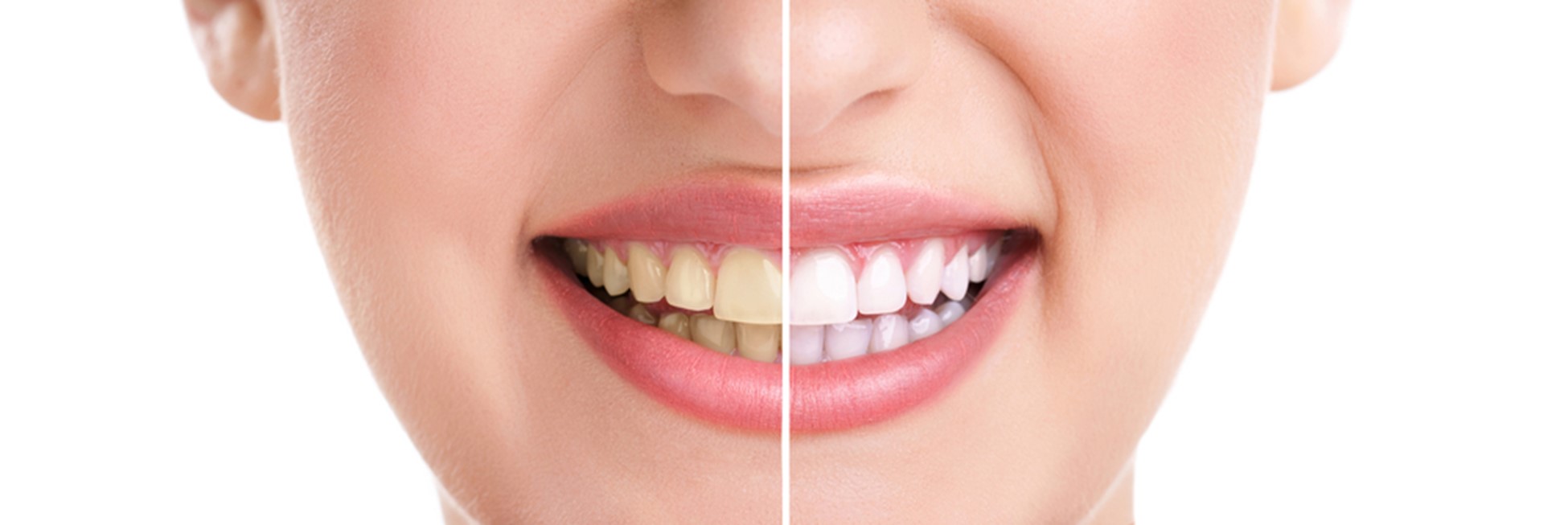 woman's teeth before and after teeth whitening treatment