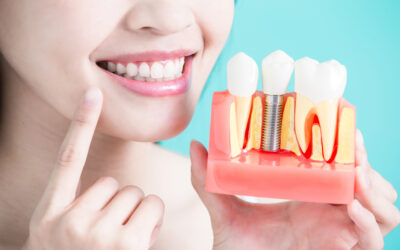 5 Fascinating Facts About Dental Implants