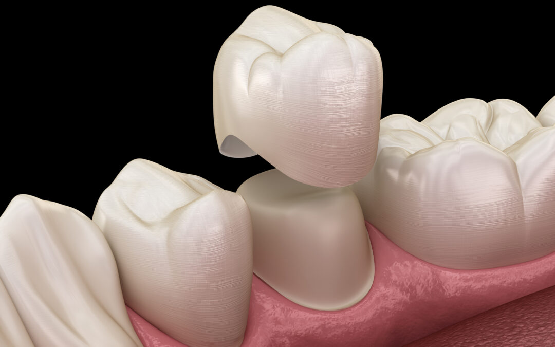Fillings vs. Dental Crowns: Choosing the Right Solution for Your Smile