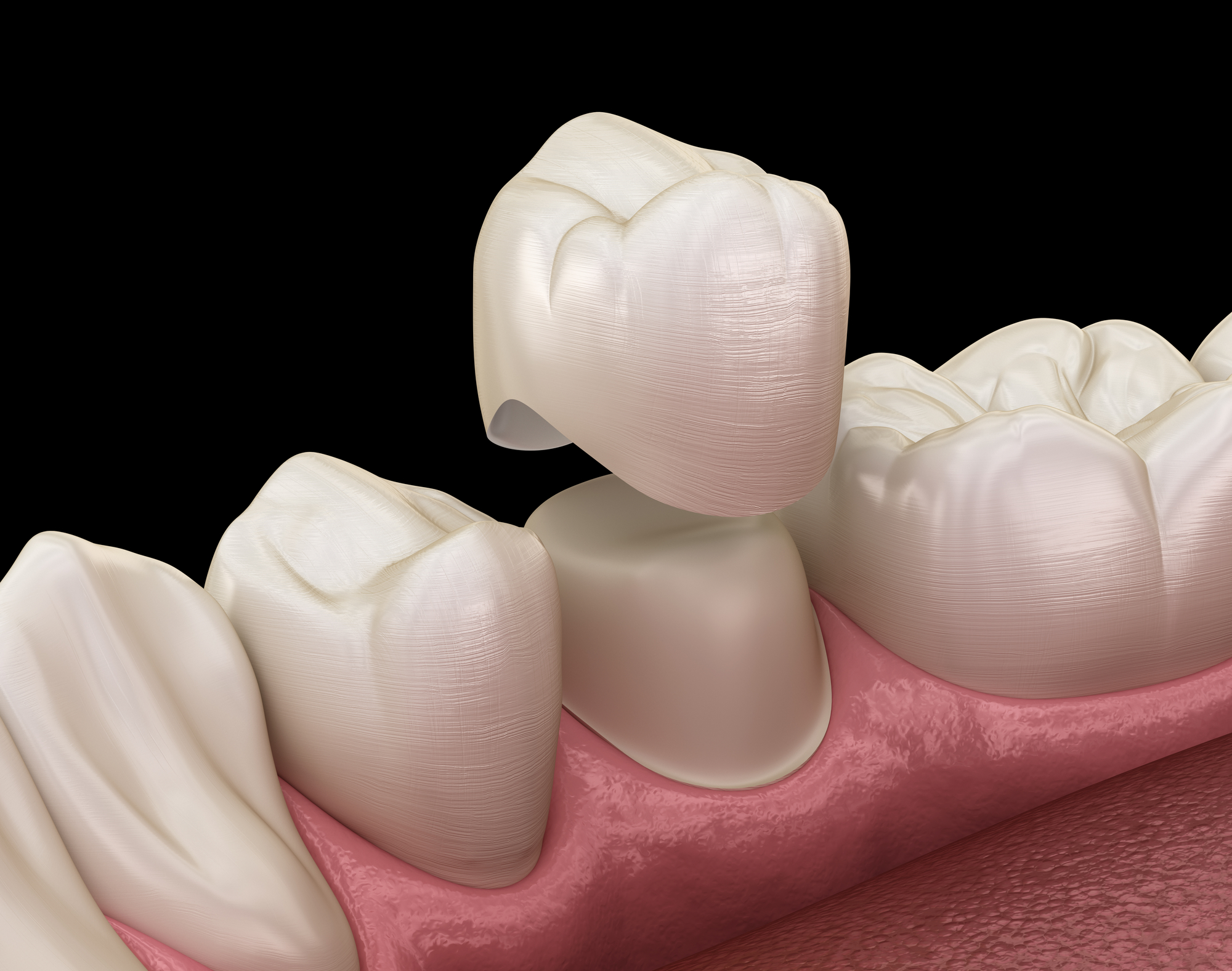 dental crown being placed over premolar