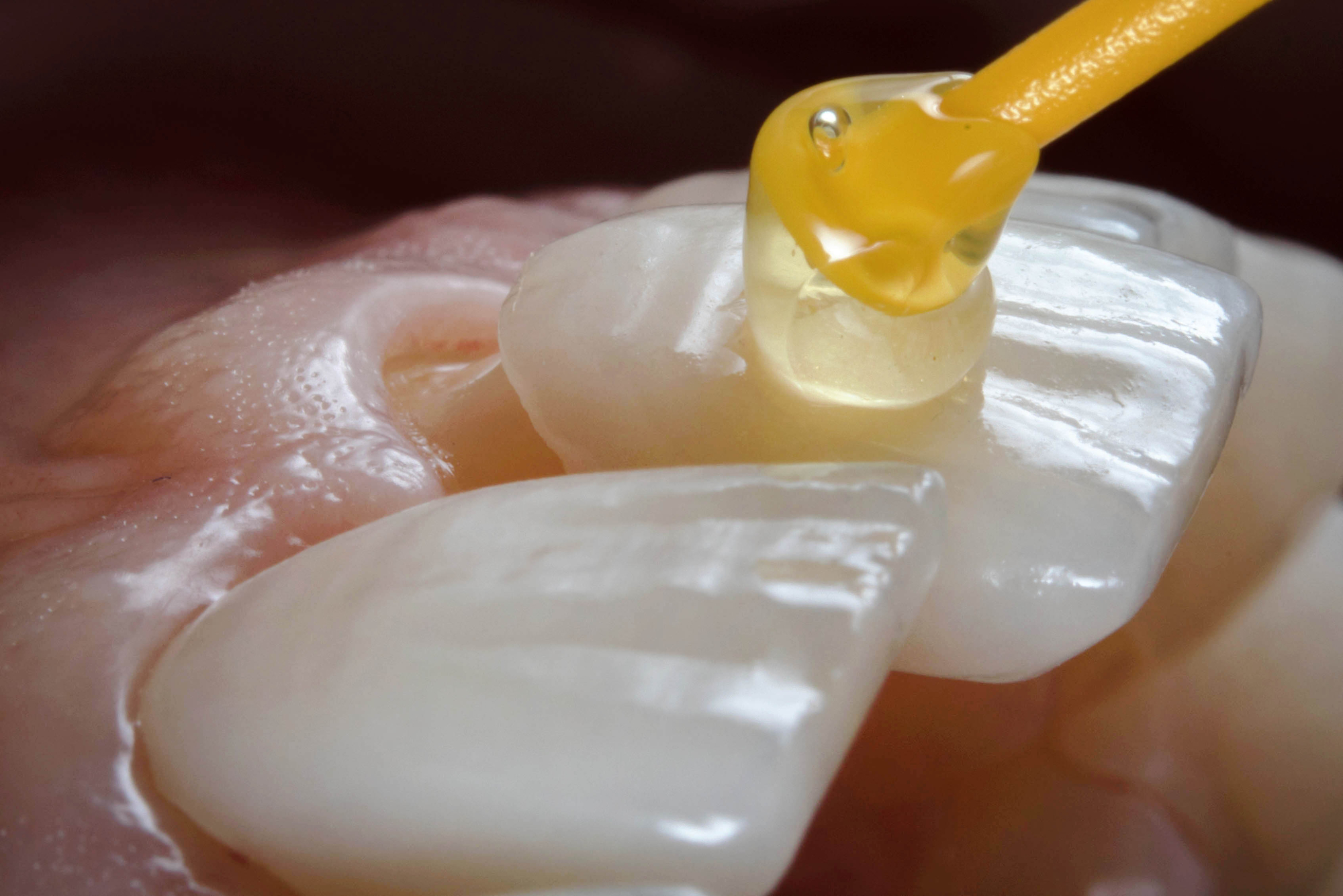 close up of dentist placing porcelain veneers with dental adhesive