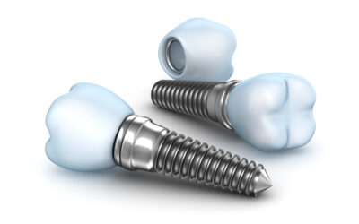 “Can dental implants fall out?”: Recognizing the Signs of Dental Implant Failure