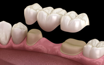 Bridging the Gap: Understanding the Difference Between Dental Bridges and Partial Dentures