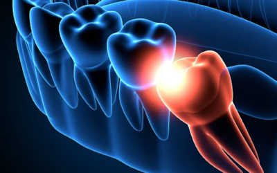 Learn the Basics About Wisdom Tooth Extraction
