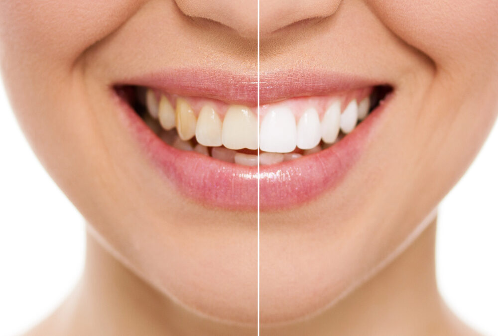 Teeth Whitening vs. Dental Veneers: Which Option is Right for You?
