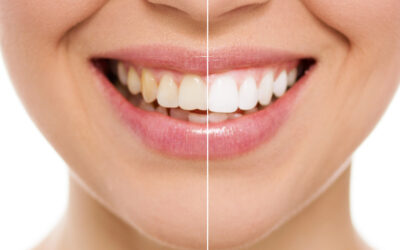 Teeth Whitening vs. Dental Veneers: Which Option is Right for You?