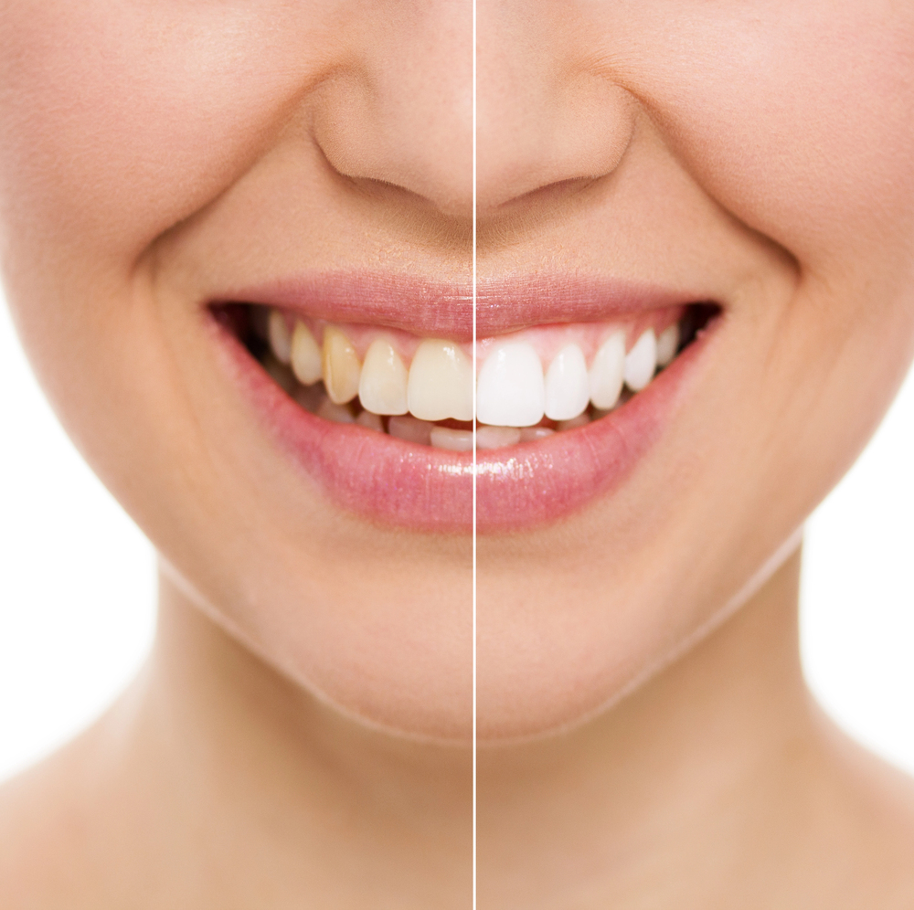 woman's teeth before and after teeth whitening and/or dental veneers