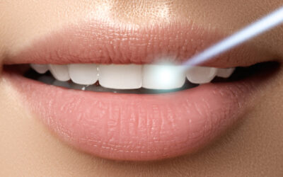 Dentist in Las Vegas Answers: Is Teeth Whitening Safe for Sensitive Teeth?