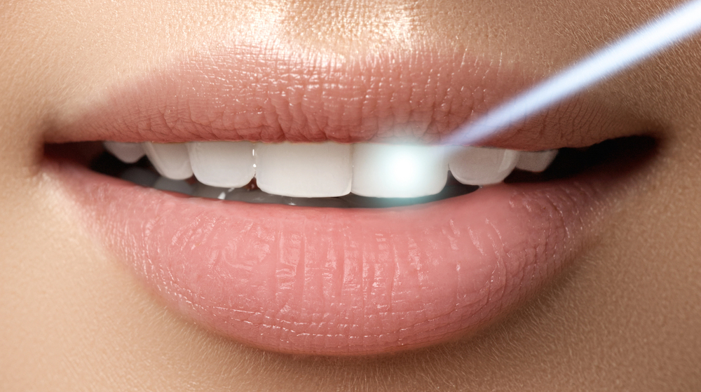 up close of laser teeth whitening on woman's teeth