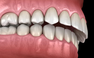 Does Invisalign Work for an Overbite?