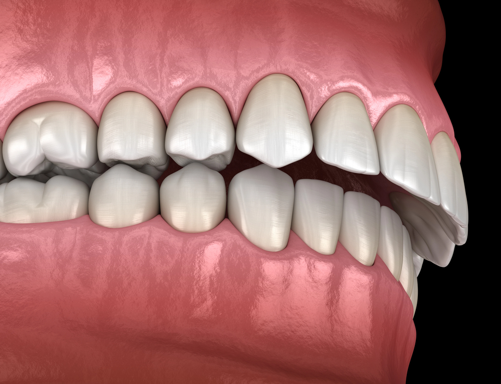 overbite
