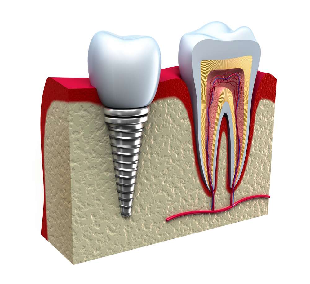 anatomy of a tooth and a dental implant
