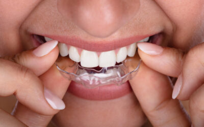 Teeth Whitening and Orthodontics: How to Brighten Your Smile with Braces or Aligners