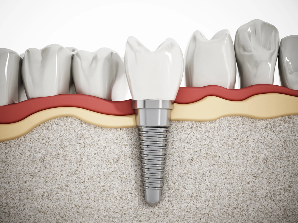 model of a dental implant placed in lower jaw