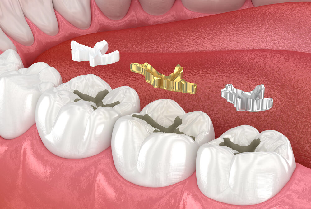 Can Dental Fillings Cause Sensitivity? Here’s the Truth