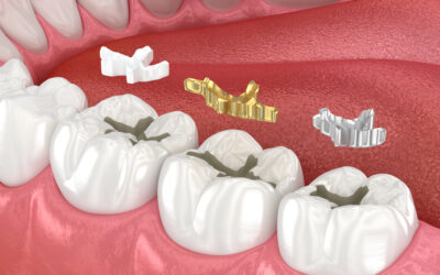 Can Dental Fillings Cause Sensitivity? Here’s the Truth