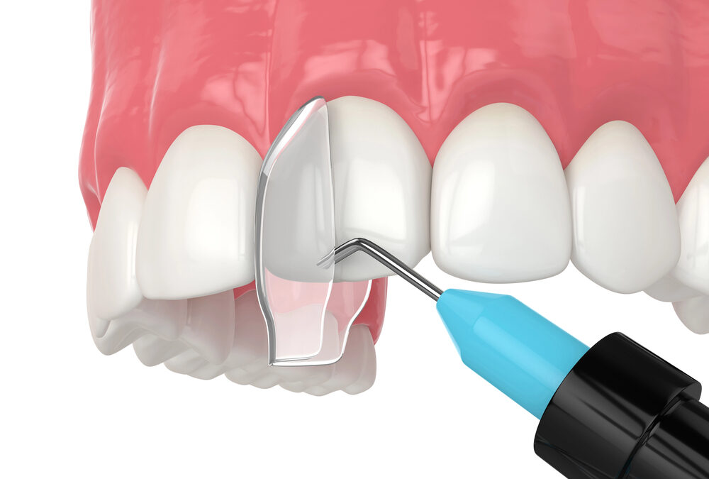 Dental Bonding & Contouring for a Sensational Smile