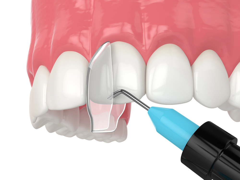 3d render of crooked tooth treatment using dental bonding procedure