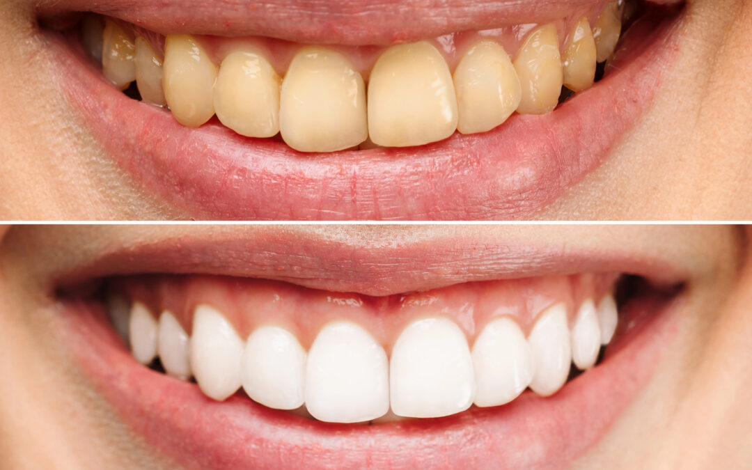 Discolored Teeth? The Surprising Causes You Didn’t See Coming