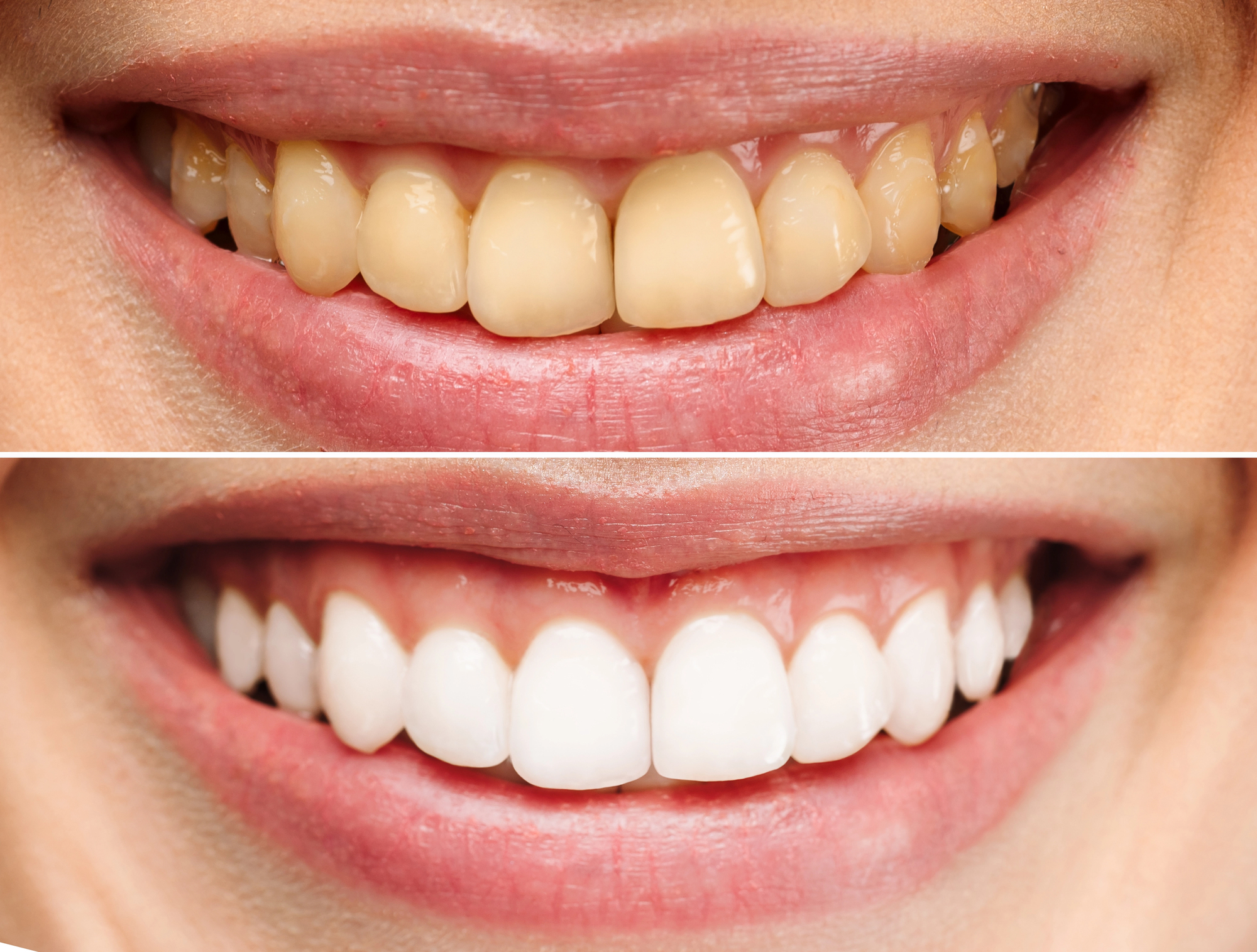 A side-by-side comparison of discolored teeth and newly-whitened teeth