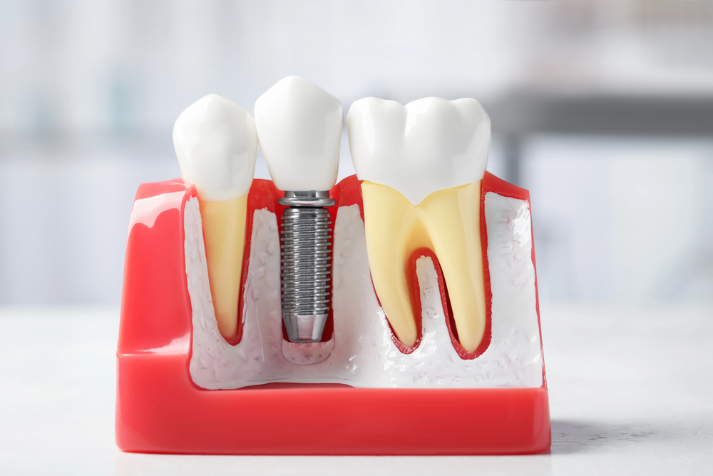 Lose the Dentures, Boost Your Confidence: Discover Dental Implants in Vegas