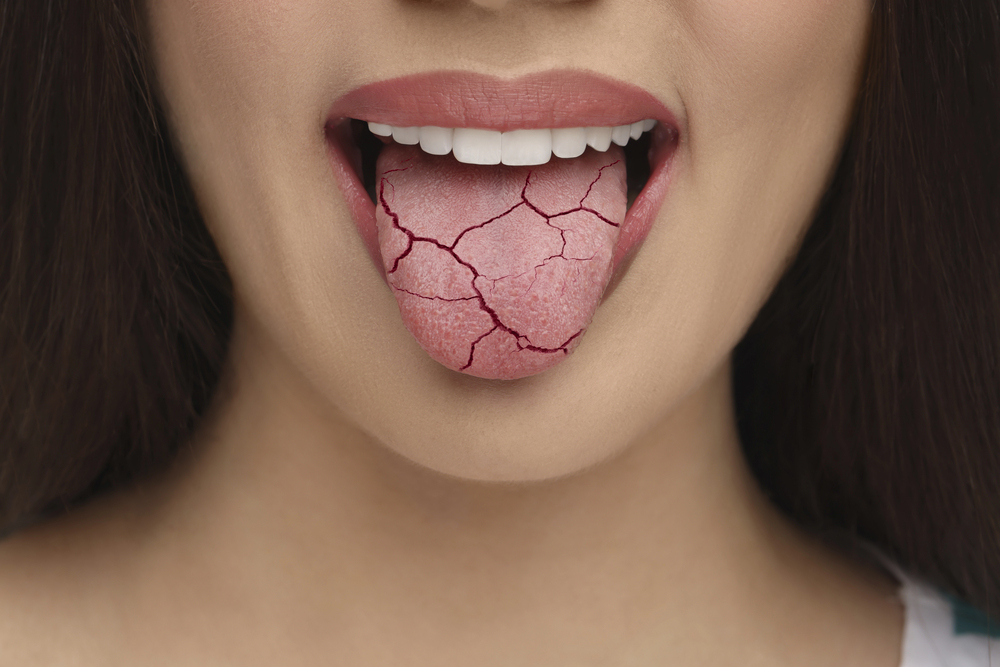 When Your Mouth Feels Like the Mojave: Real Relief for Dry Mouth