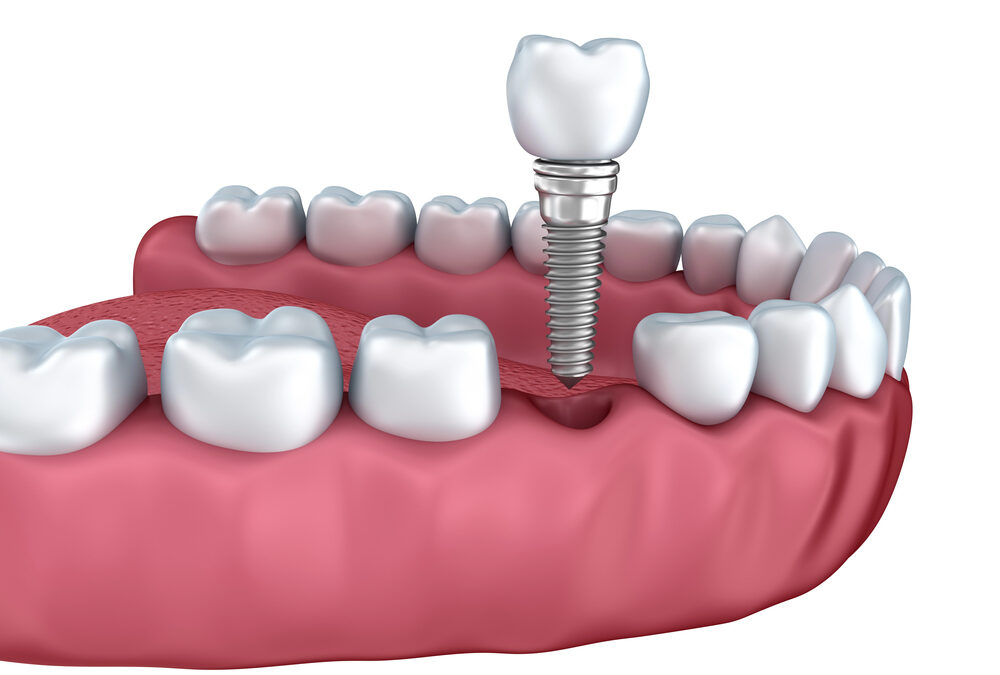 When Are Dental Implants A Great Decision?