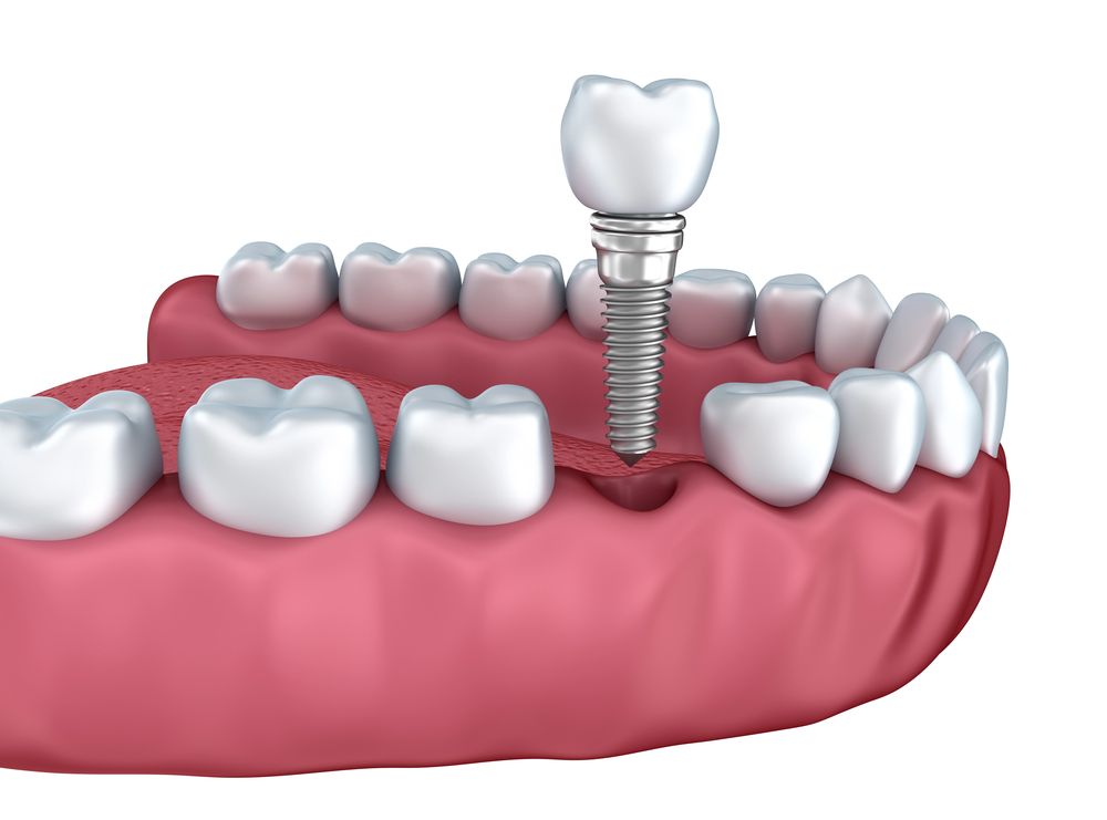 dental implants in lower jaw